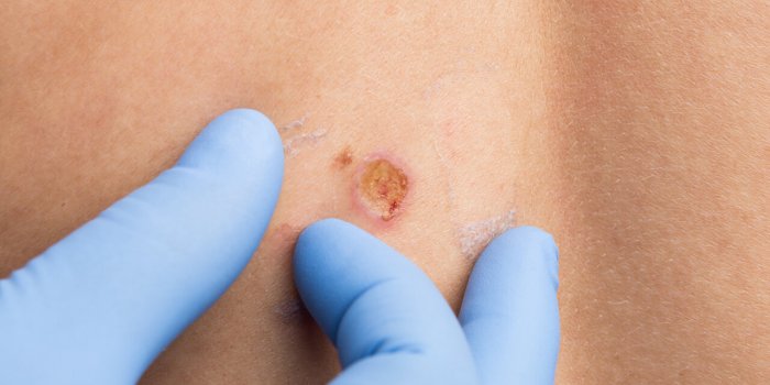 Cancer de la peau : ces 5 signes qui doivent inquiÃ©ter