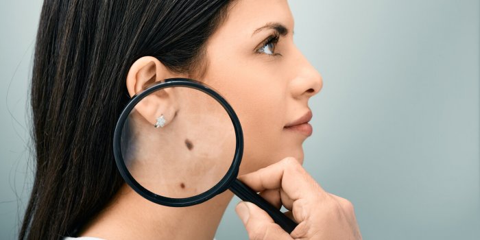 Cancer de la peau : ces 5 signes qui doivent inquiÃ©ter
