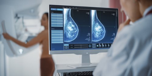 Cancer du sein : la mammographie est-elle efficace apres 75 ans ?