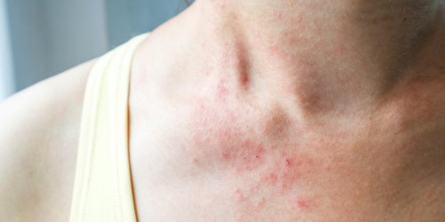Eczema allergique : les symptomes